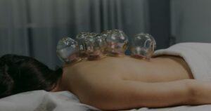 Coral Gables Cupping Therapy