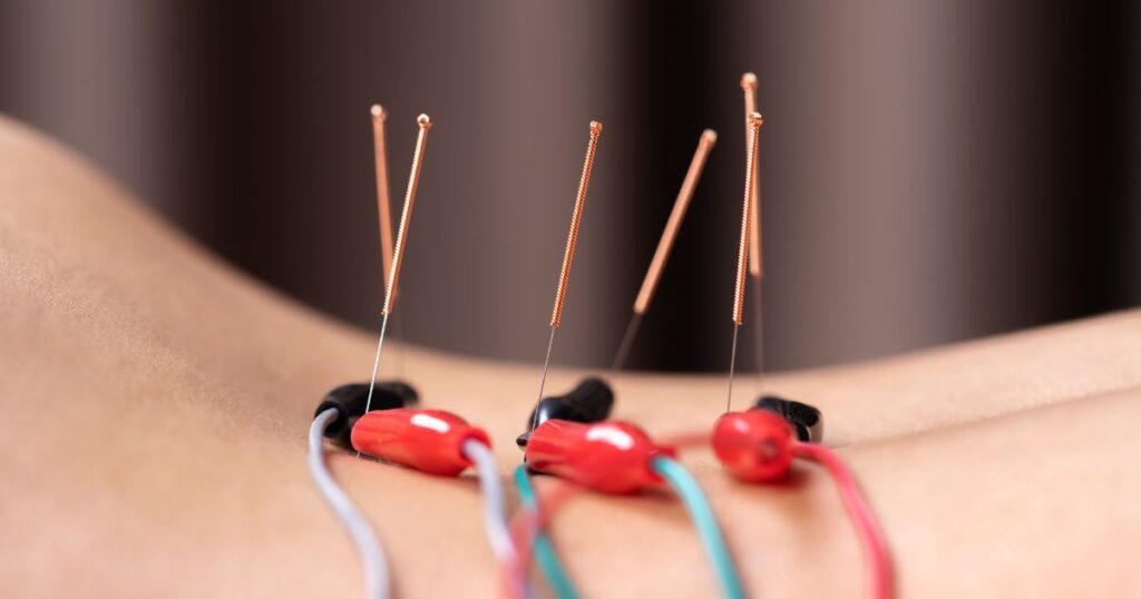 sports medicine acupuncture