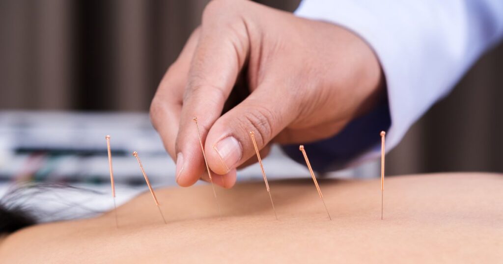 sports medicine acupuncture