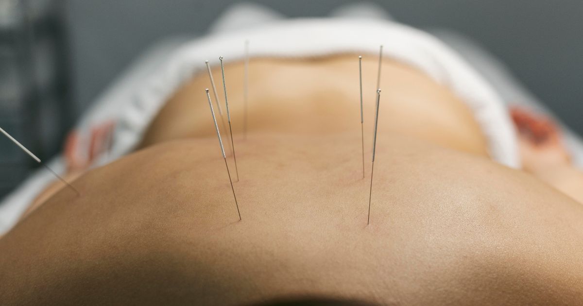 sports medicine acupuncture in miami