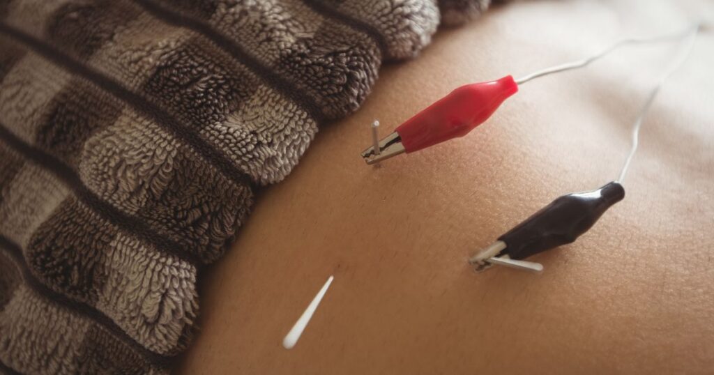 fertility acupuncture in Miami