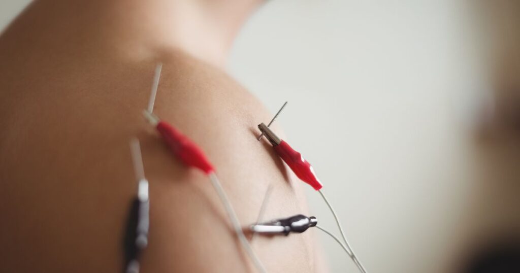 acupuncture for hormonal balance in miami