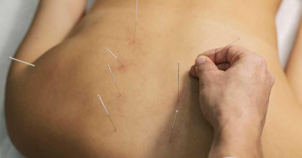 acupuncture for hormone imbalance